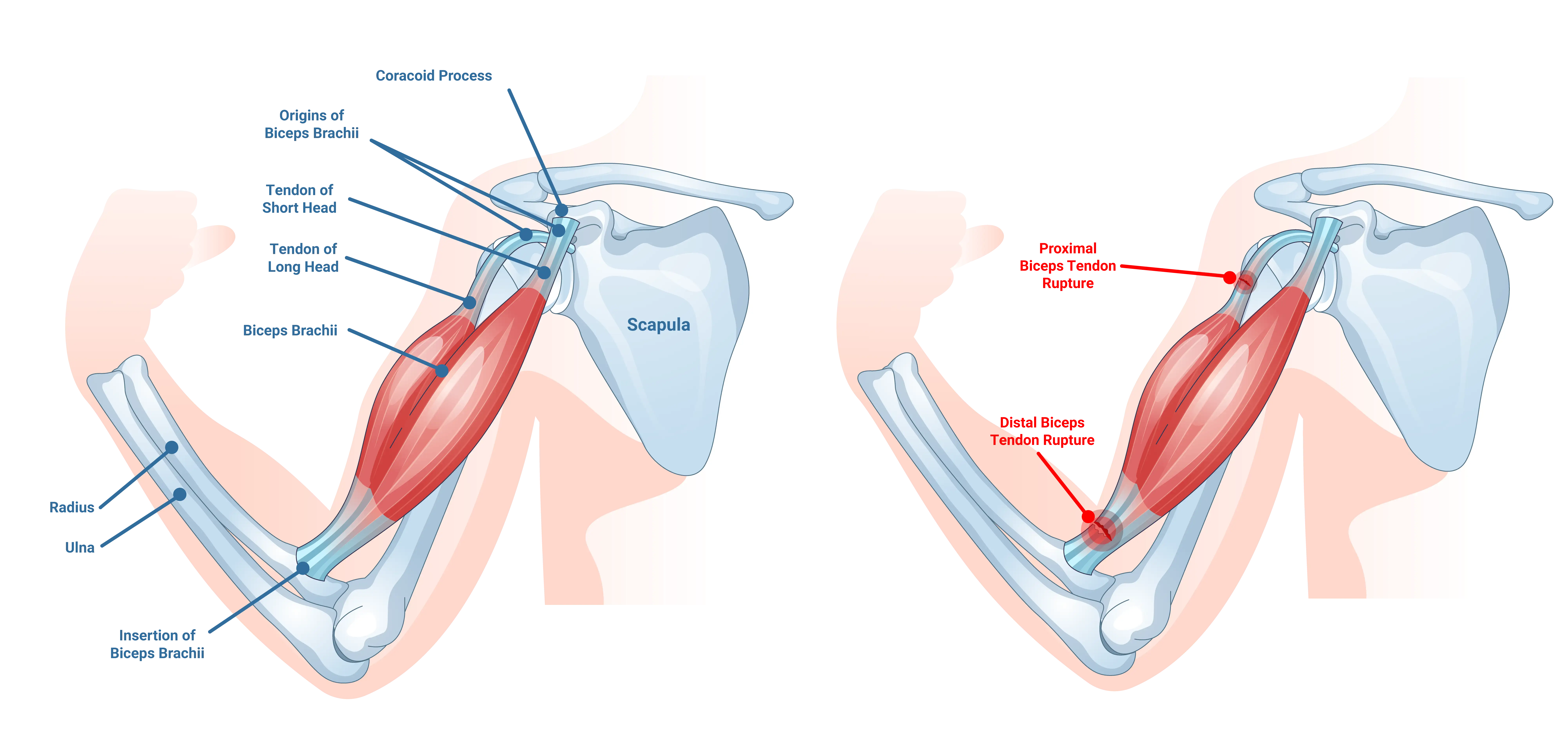 Bicep tendon rupture Anatomical Graphic
