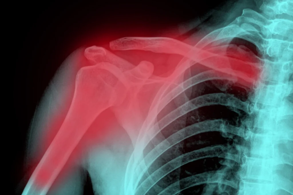 X-Ray Of Shoulder