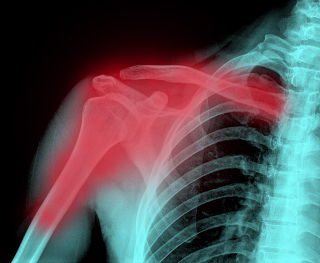 Anatomy of a Fractured Shoulder