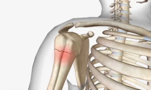 Proximal Humerus Fracture Treatment