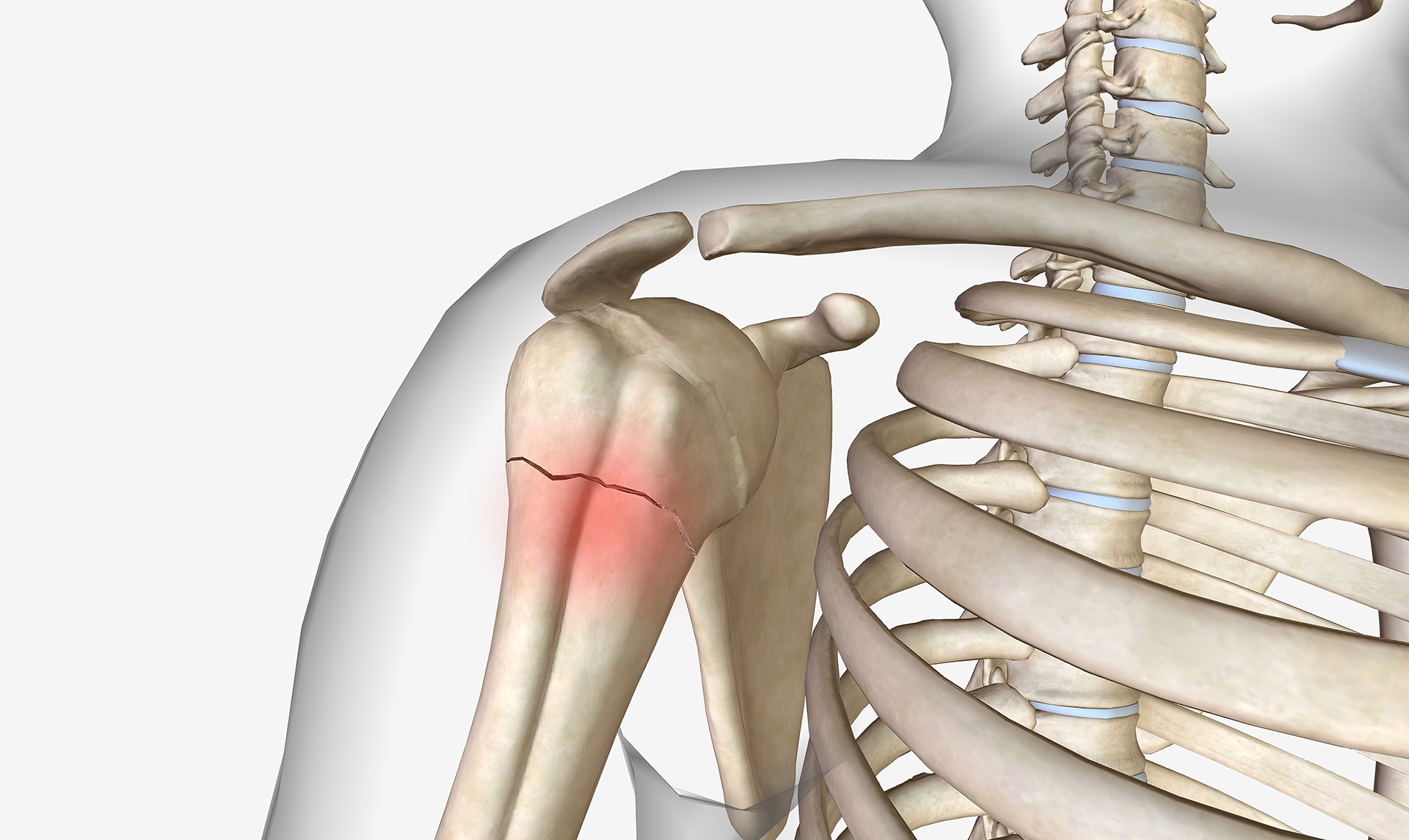 Proximal Humerus Fracture Treatment