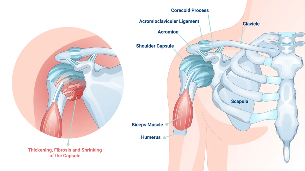 frozen shoulder diagram