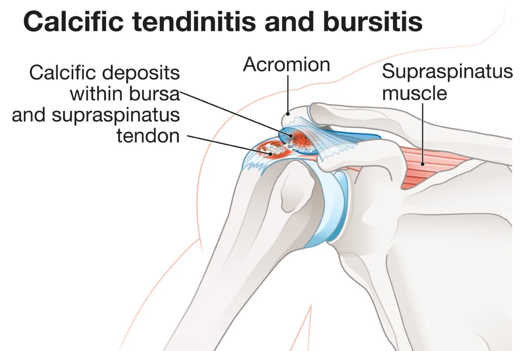 calcific tendinitis diagram
