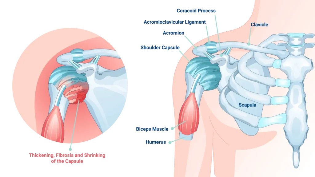 frozen shoulder comparison frozen shoulder diagram with labels, with a focus on the frozen shoulder capsule.