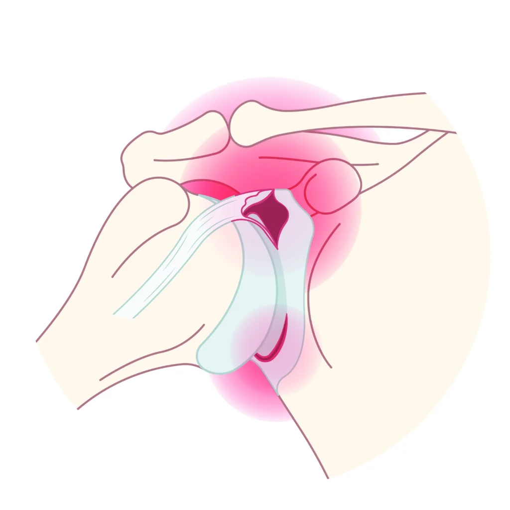 Bankart Tear An anatomical depiction of a bankart tear in the shoulder