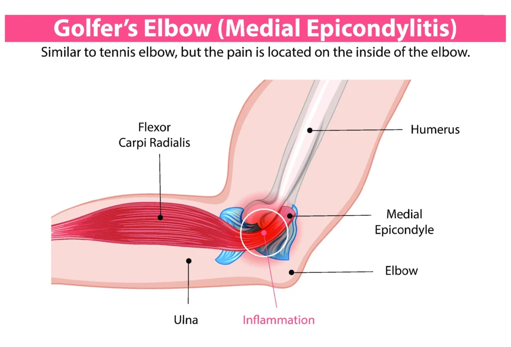 golfers elbow