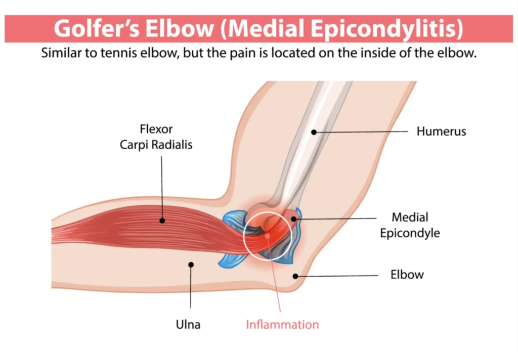 golfers elbow diagram Golfers elbow diagram, highlighting the inflammation found in the anatomy of the elbow.
