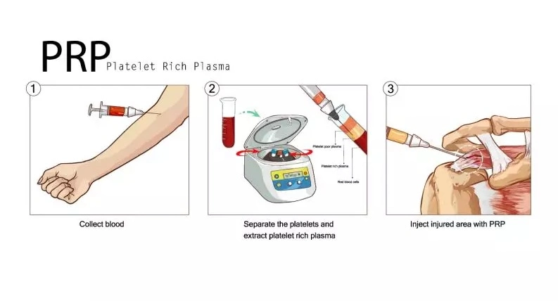 prp step by step guide in elbow
