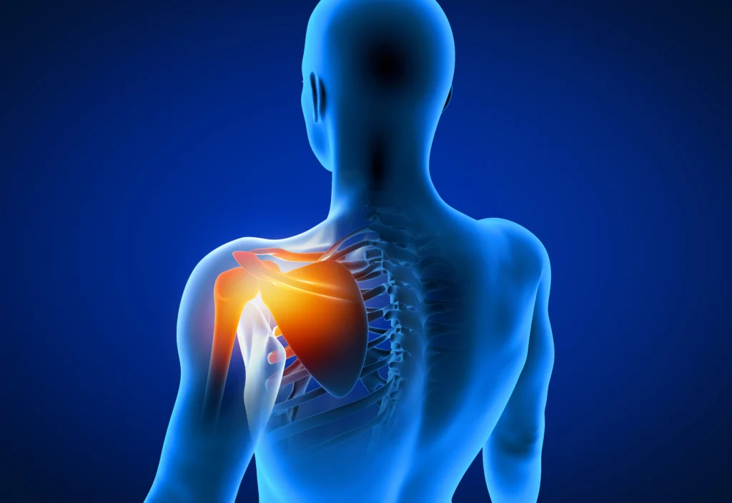 shoulder_replacement_diagram visual of a patient in need of shoulder replacement surgery for pain.